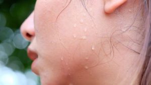 Chăm Sóc Da Sau Peel