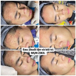 Hai Sản Phẩm Mụn ZIKII