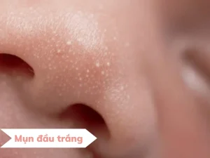 Các loại mụn trên mặt