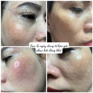 Tế Bào Gốc ZIKII